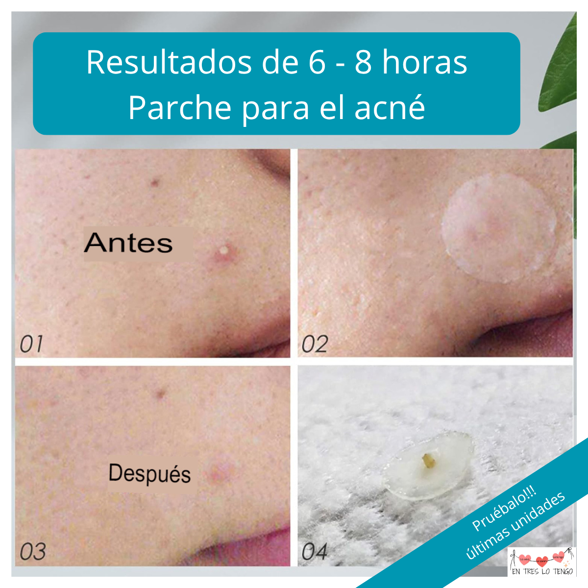Parches para acné